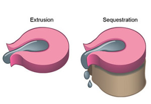 spinal disc herniation illustration